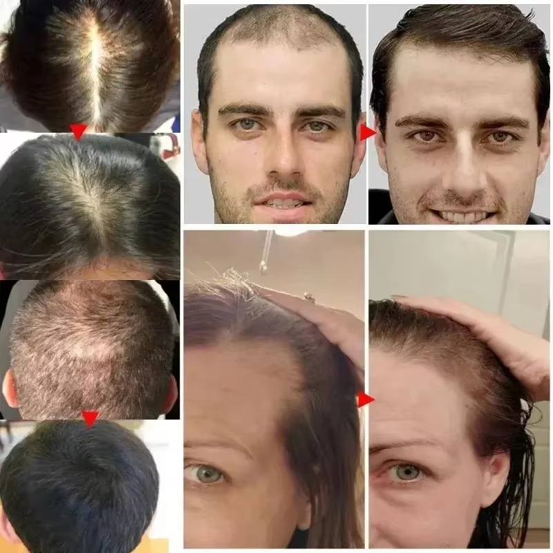 Tobs Hair growth treatment Oil for hairloss